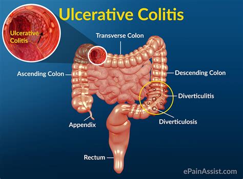 Dating site for ulcerative colitis